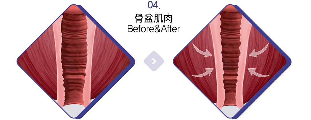 骨盆肌肉 Before&After